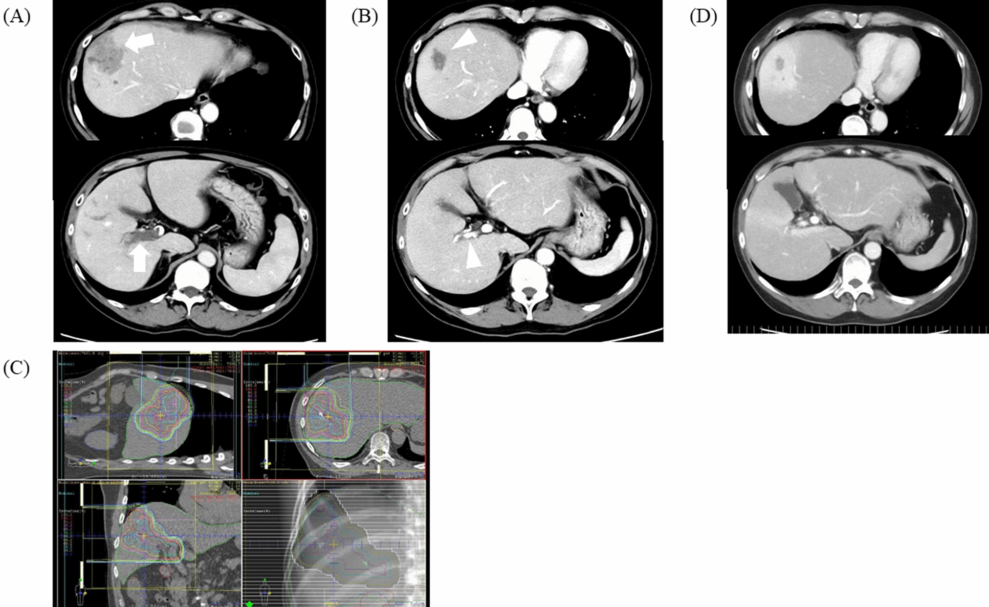 Novel concept of “sequential particle radiotherapy” with atezolizumab plus bevacizumab for hepatocellular carcinoma with portal vein tumor thrombus