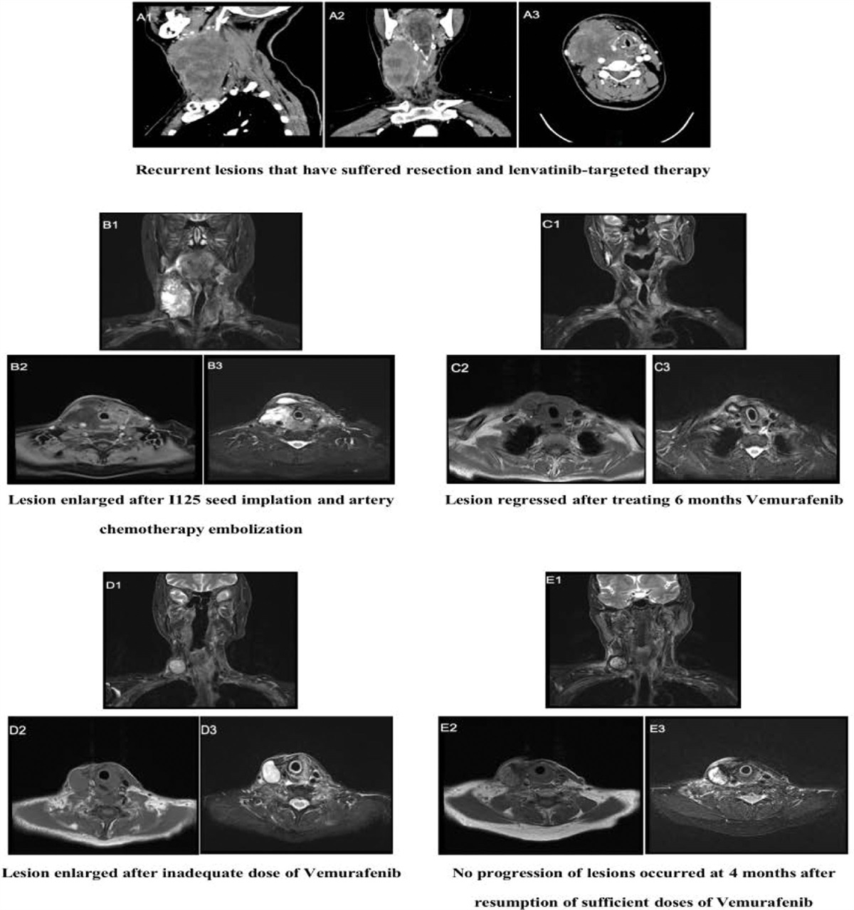 Clinical responses to vemurafenib in postoperative recurrence of papillary thyroid carcinoma with esophageal fistula: A case report