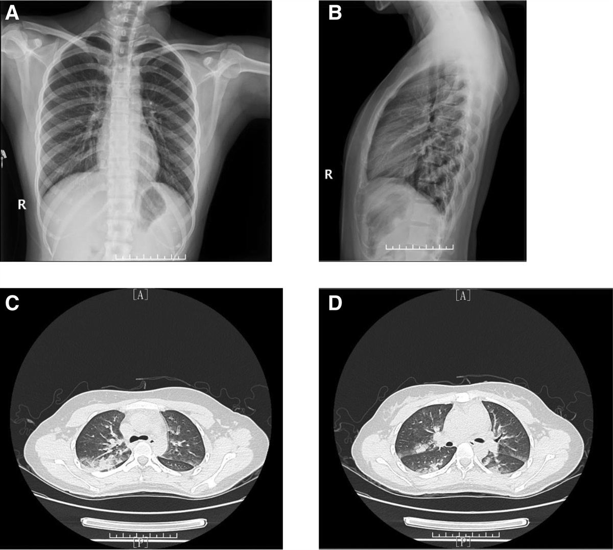 Negative pressure pulmonary edema after laparoscopic cholecystectomy: A case report and literature review