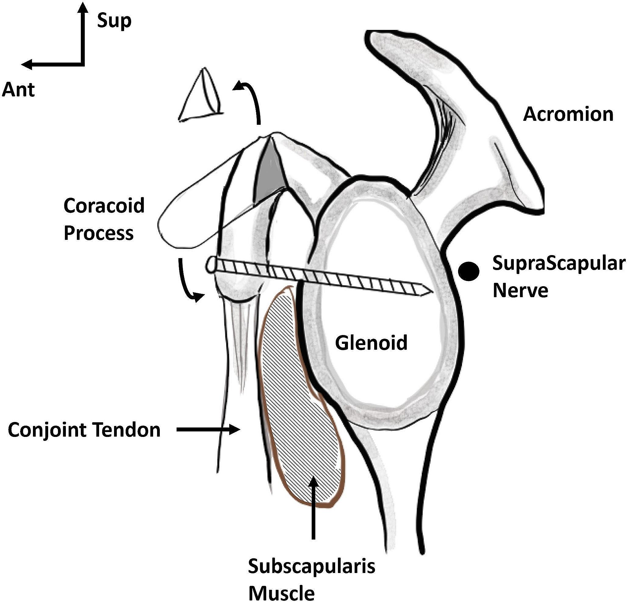 Risk of suprascapular nerve injury in open Trillat procedure: an anatomical study