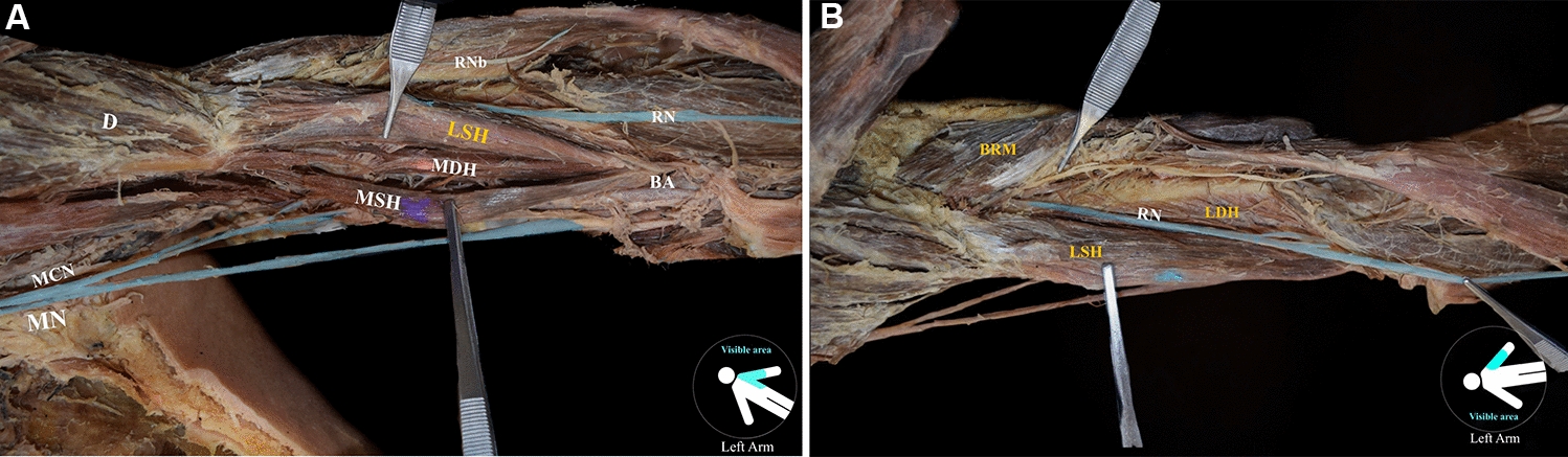 A bilateral four-headed brachialis muscle with a variant innervation: a cadaveric report with possible clinical implications