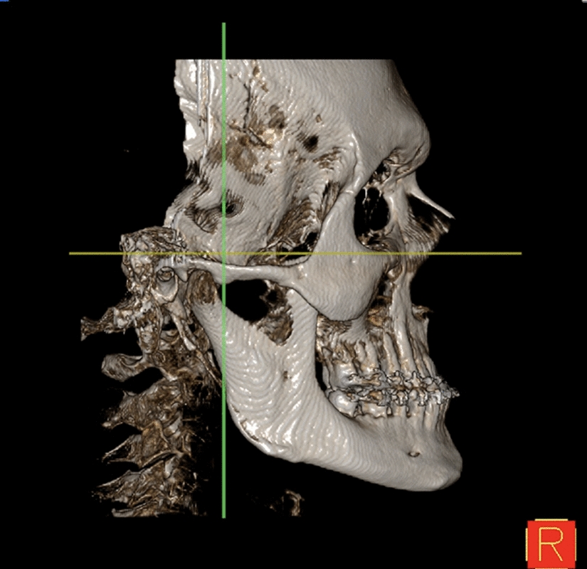Comprehensive analysis of lateral nasal wall anatomy to optimize the osteotomy in different skeletal patterns