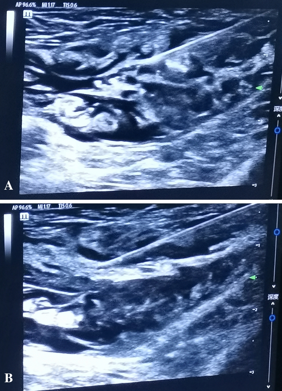 Feasibility of tension-free repair of inguinal hernia in senile patients under ultrasound-guided local nerve block