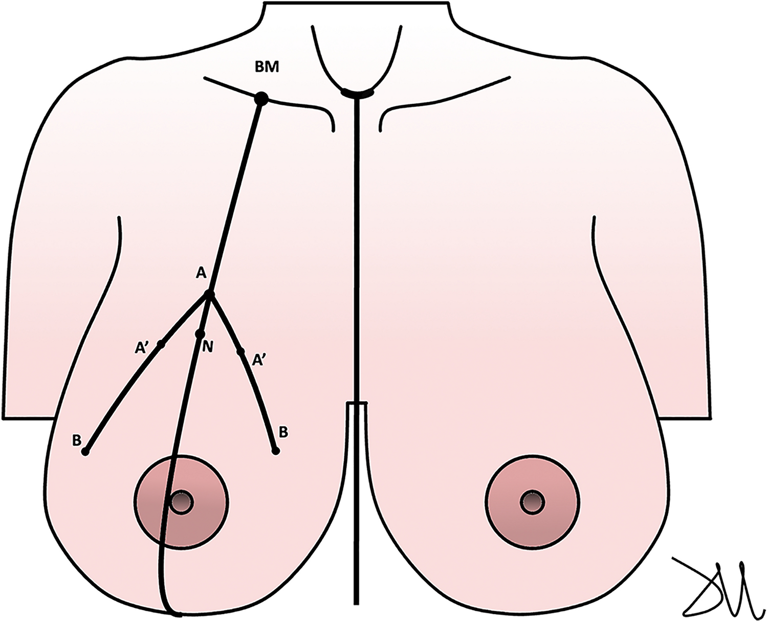 Marking the nipple–areola complex in mastopexy and reduction mammoplasty: a geometrical method