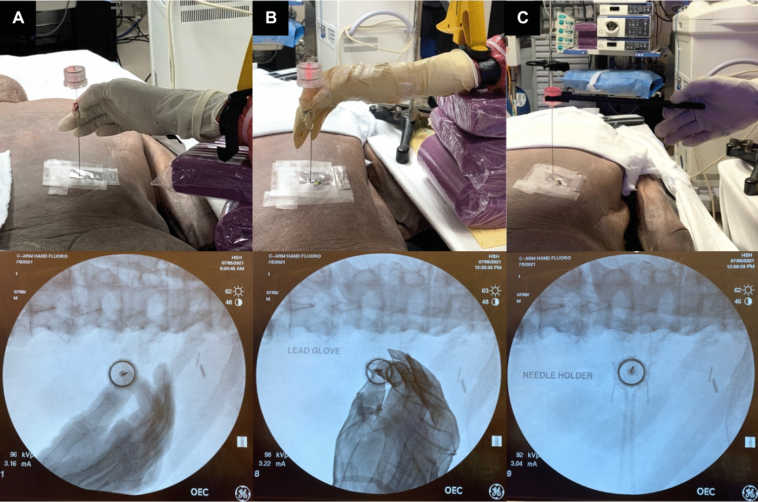 Reducing hand radiation during renal access for percutaneous nephrolithotomy: a comparison of radiation reduction techniques