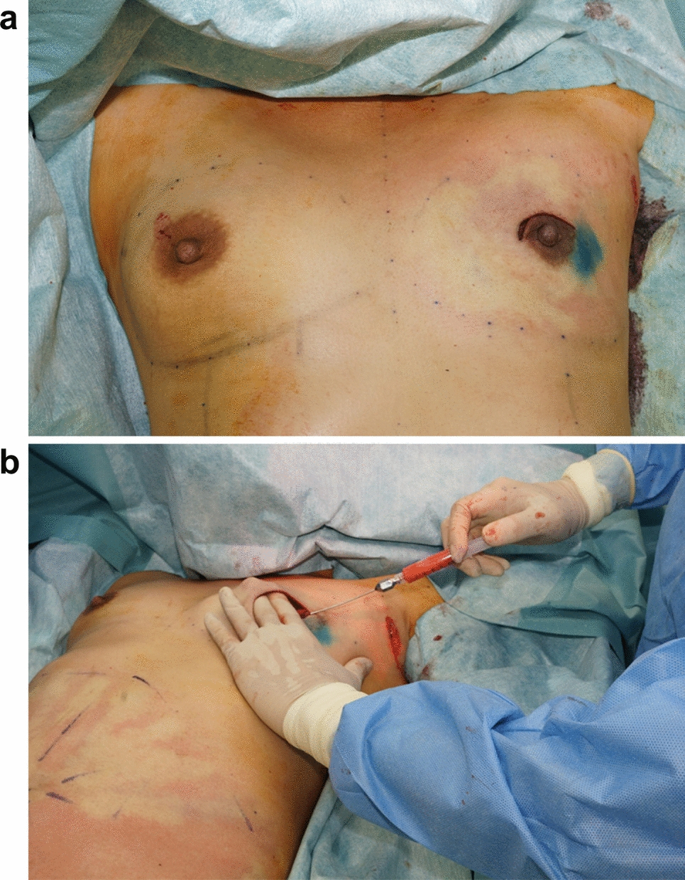 Endoscopic mastectomy followed by immediate breast reconstruction with fat grafting for breast cancer