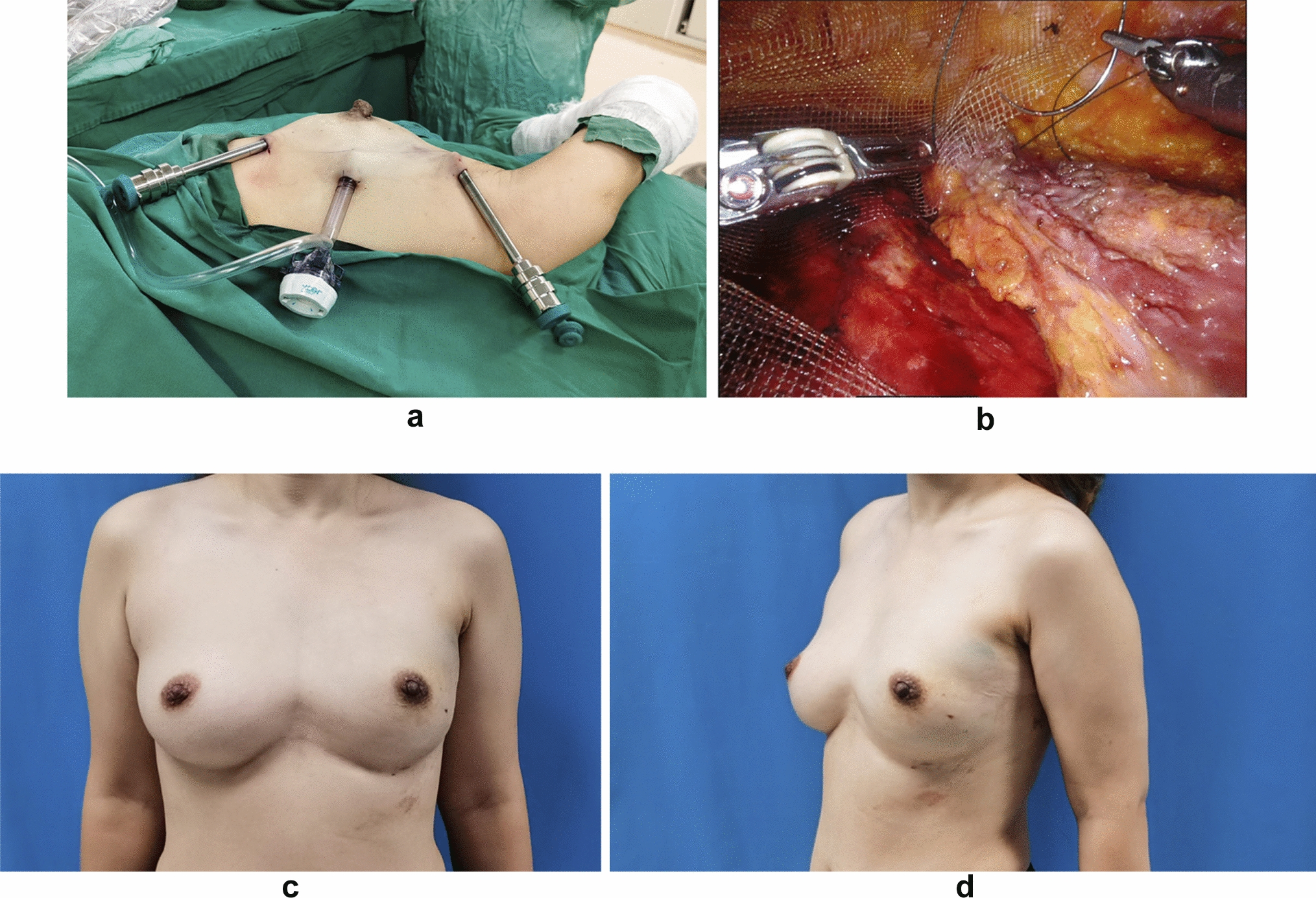 Patient-reported outcomes of mesh in minimally invasive (laparoscopic/robot-assisted) immediate subpectoral prosthesis breast reconstruction: a retrospective study