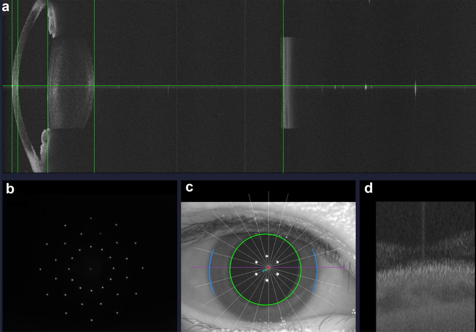 Evaluation of a new dynamic real-time visualization 25 kHz swept-source optical coherence tomography based biometer