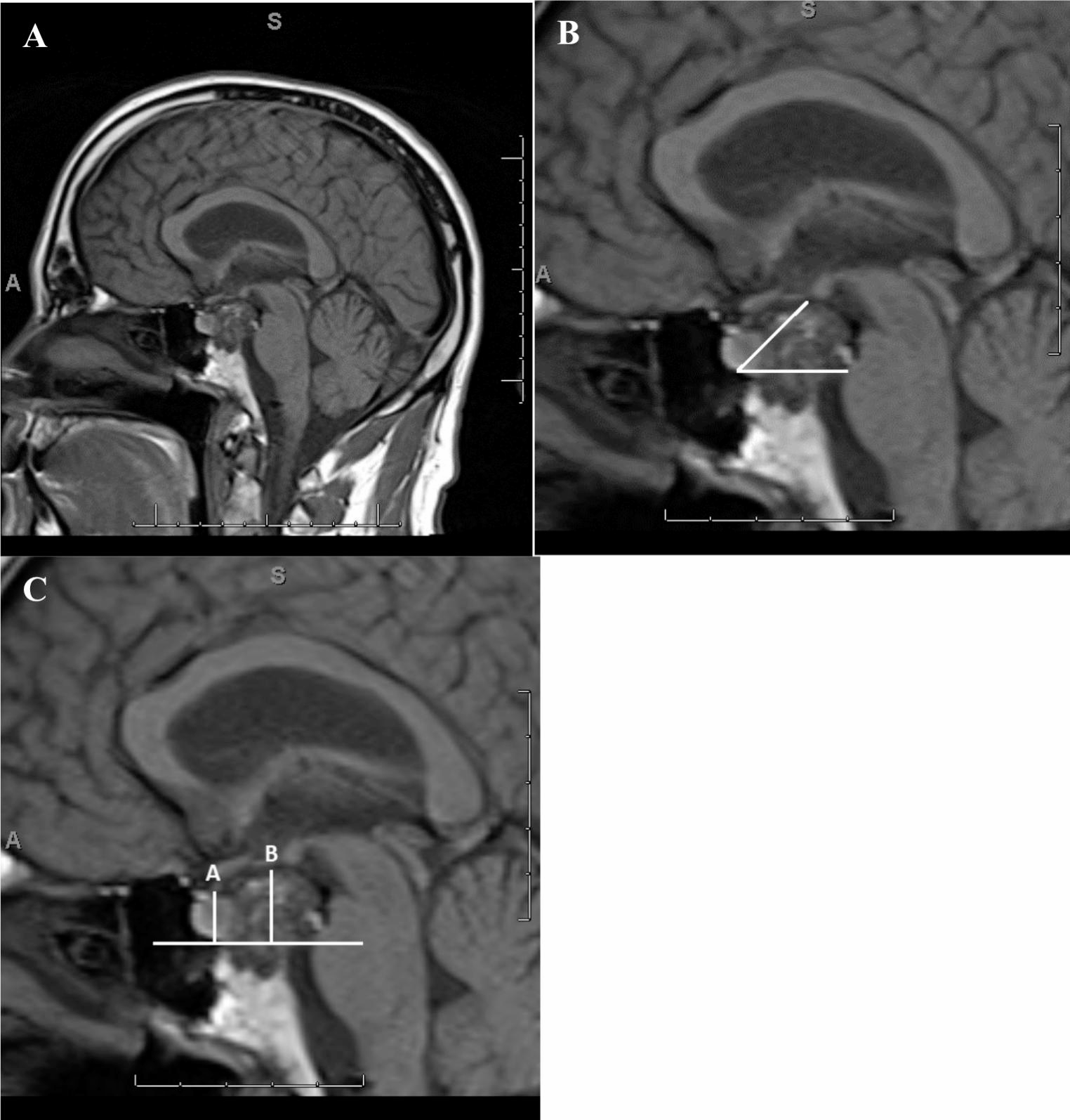 Correction: incidence of postoperative hyponatremia after endoscopic endonasal pituitary transposition for skull base pathologies