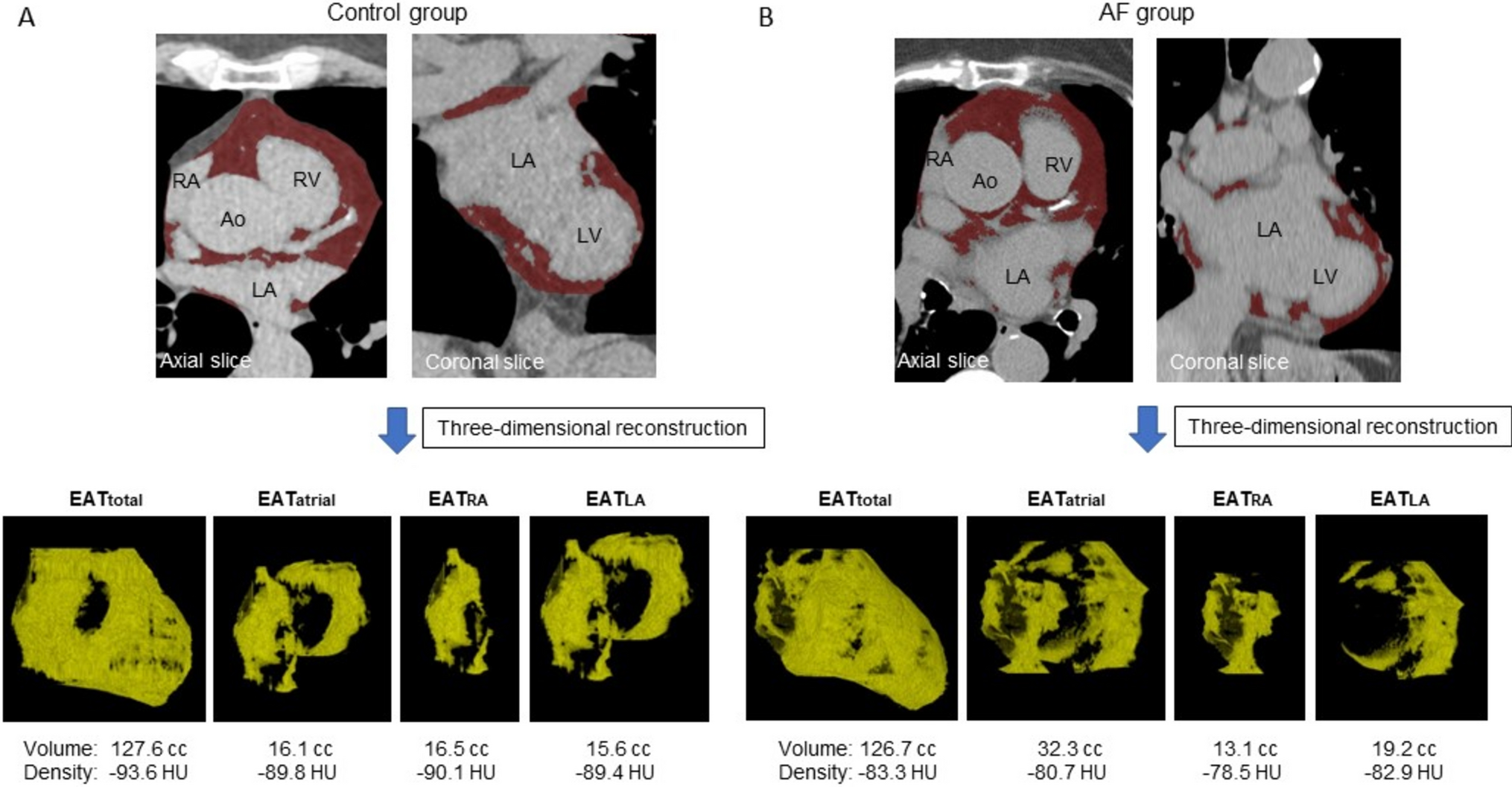 Epicardial adipose tissue density predicts the presence of atrial fibrillation and its recurrence after catheter ablation: three-dimensional reconstructed image analysis