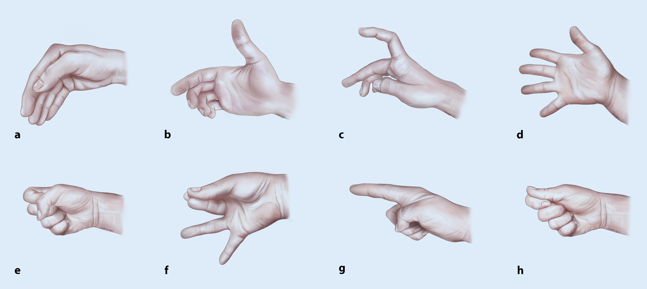Ictal hand signs: Minimal previous attention to these diagnostic indicators