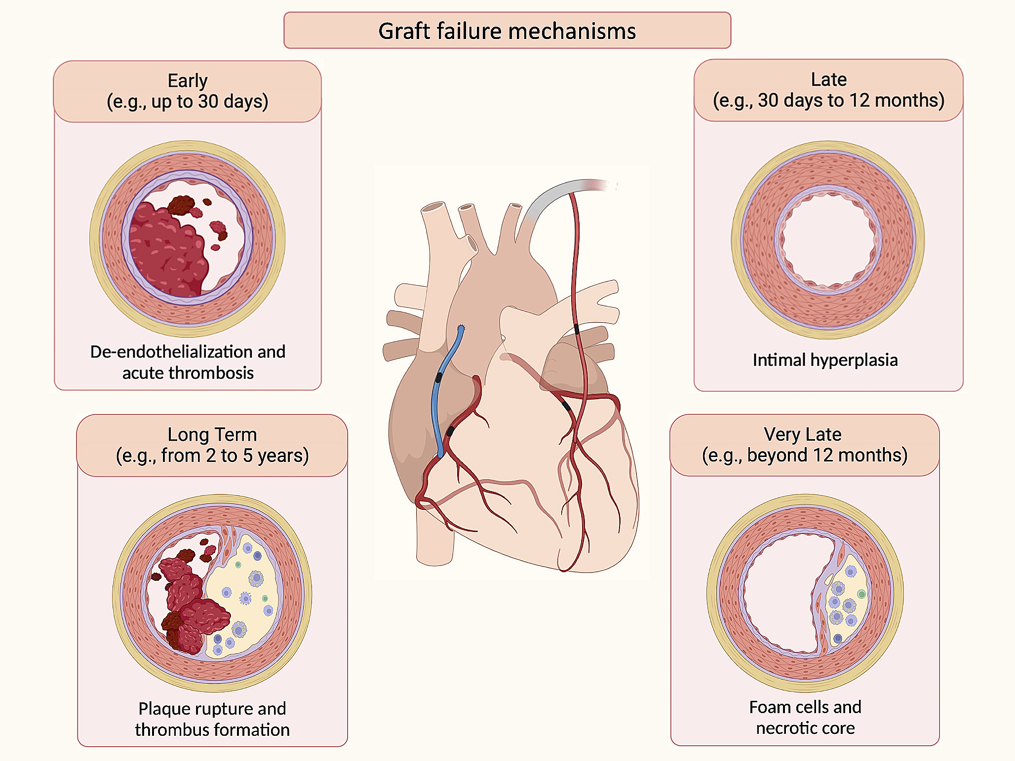 Antithrombotic strategies for preventing graft failure in coronary artery bypass graft