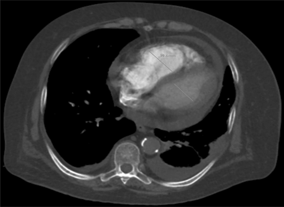 Computed tomography-based radiomics model to predict adverse clinical outcomes in acute pulmonary embolism
