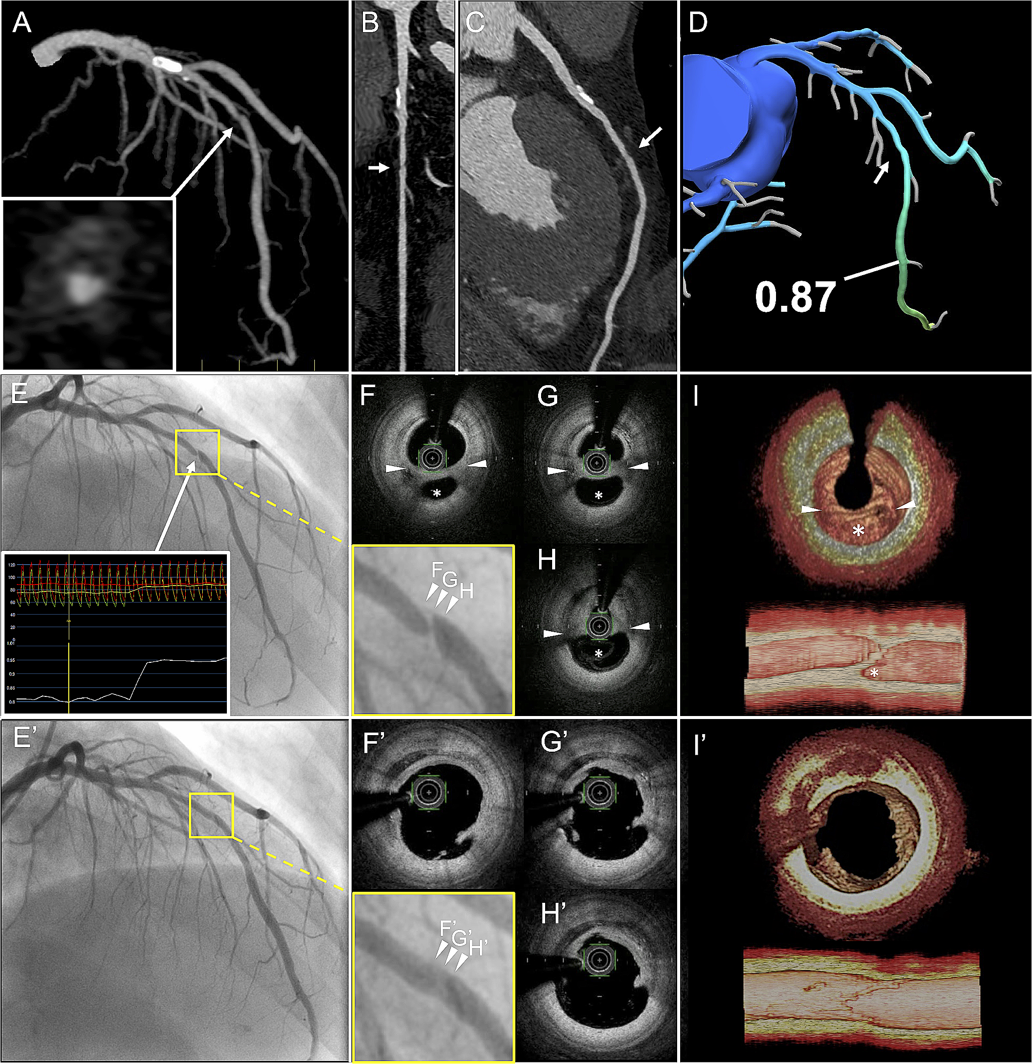 Lesion of slit-like stenosis underestimated by fractional flow reserve based on computed tomography images