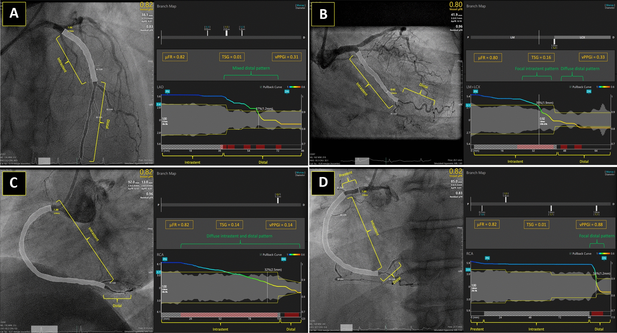 Angiography-derived physiological assessment after percutaneous coronary intervention of chronic total occlusions