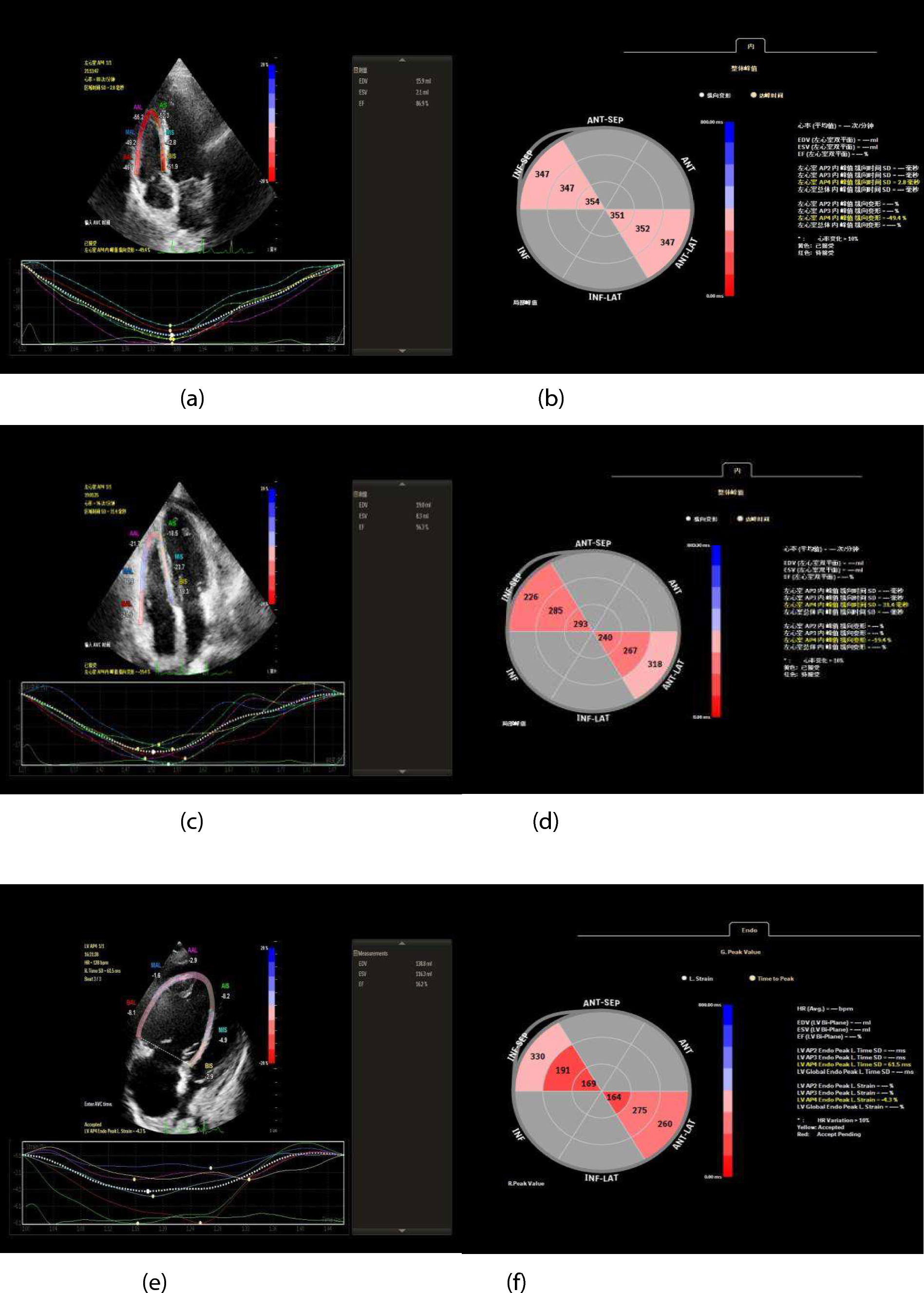 Right ventricular dyssynchrony for the prediction of prognosis in patients with systemic lupus erythematosus-aaociated pulmonary arterial hypertension: a study with two-dimensional speckle tracking