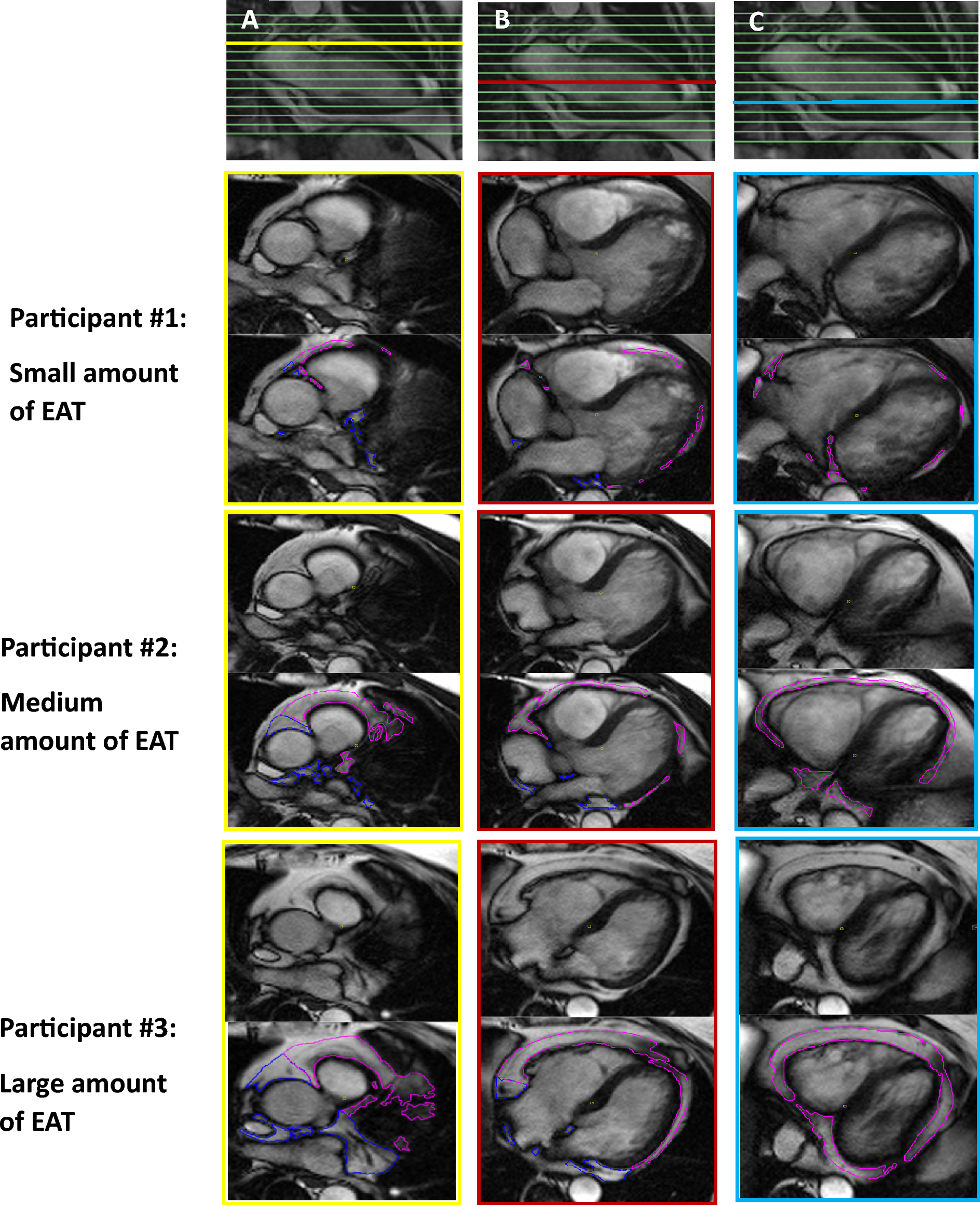 Epicardial adipose tissue and subclinical incident atrial fibrillation as detected by continuous monitoring: a cardiac magnetic resonance imaging study