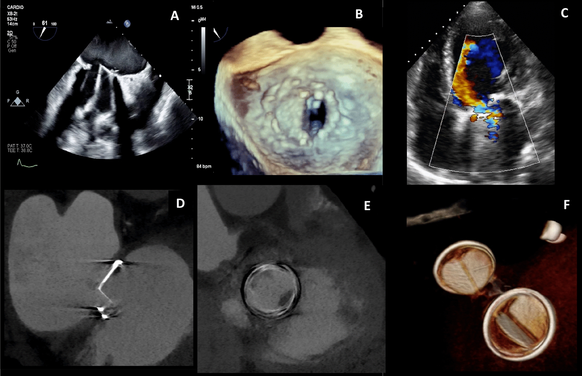 A challenging case of prosthetic mitral valve dysfunction: the value of multimodality imaging