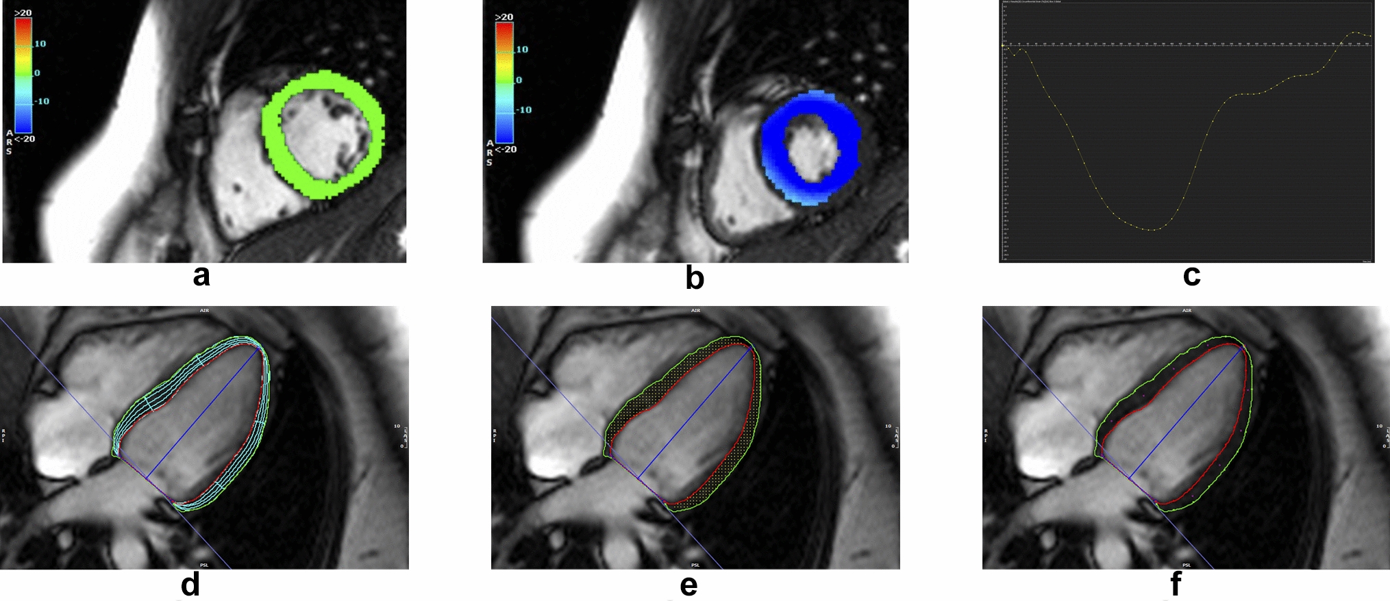Adiposity influences on myocardial deformation: a cardiovascular magnetic resonance feature tracking study in people with overweight to obesity without established cardiovascular disease