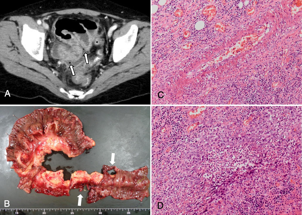 Granulomatosis With Polyangiitis Presenting With Intestinal Perforation