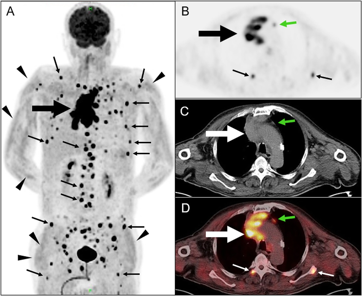 FDG PET/CT Findings of a Small Cell Carcinoma of the Lung Presented as Diffuse Dermatomyositis