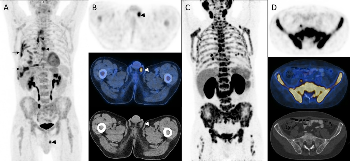 18F-FDG and 68Ga-PSMA PET/CT in Paratesticular Mesothelioma