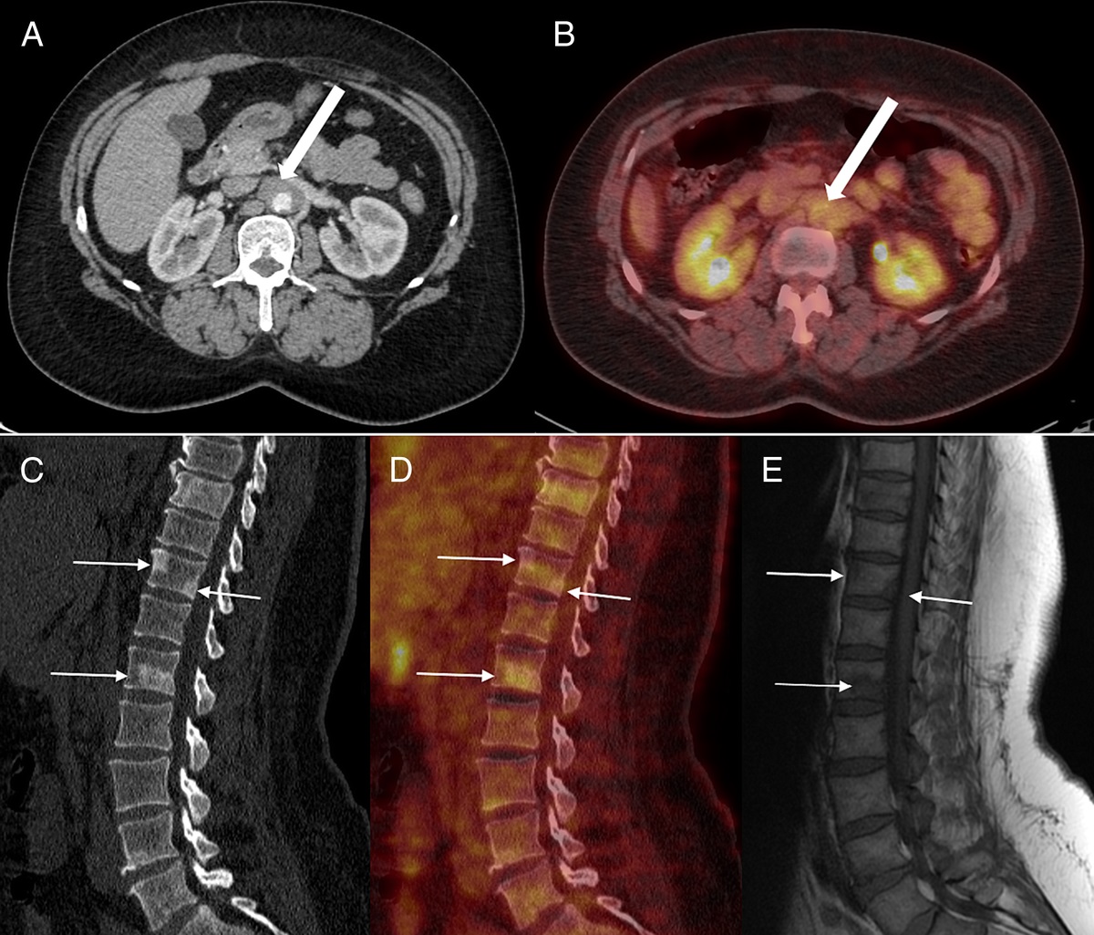 Typical Bone Scintigraphy Presentation of Erdheim-Chester Disease in a Patient Diagnosed With IgG4-Related Disease