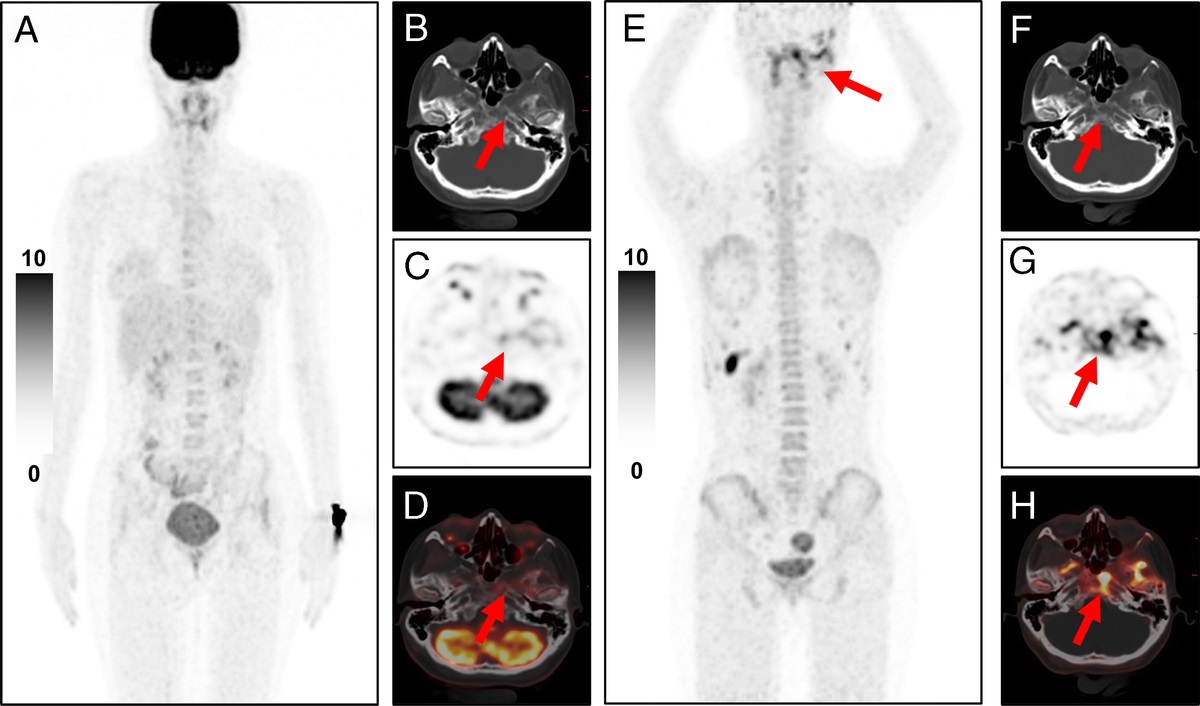 Comparison of 18F-FAPI and 18F-FDG PET/CT in a Patient With Fibrous Dysplasia