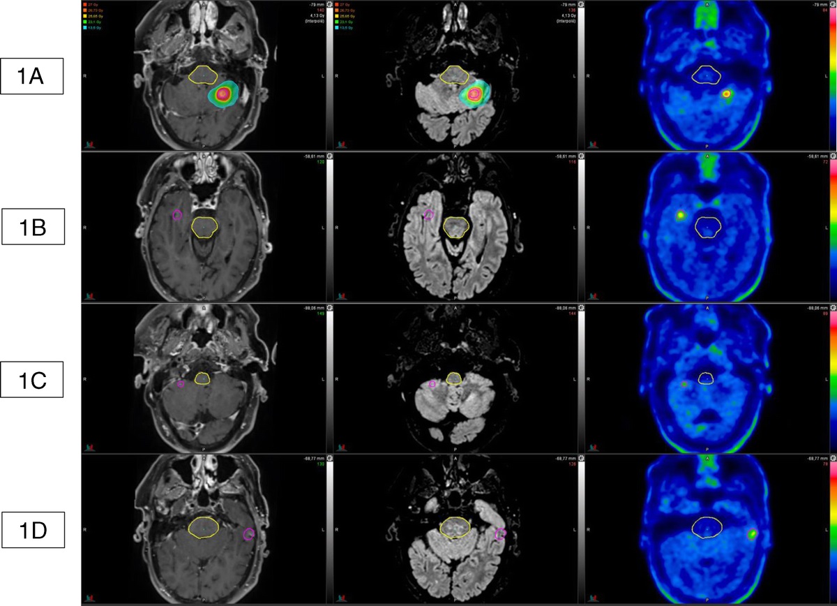 Mismatch Between Brain MRIs and 18F-DOPA PET/CT: Impact on the Management of a Long Survivor With EGFR-Mutated Lung Adenocarcinoma