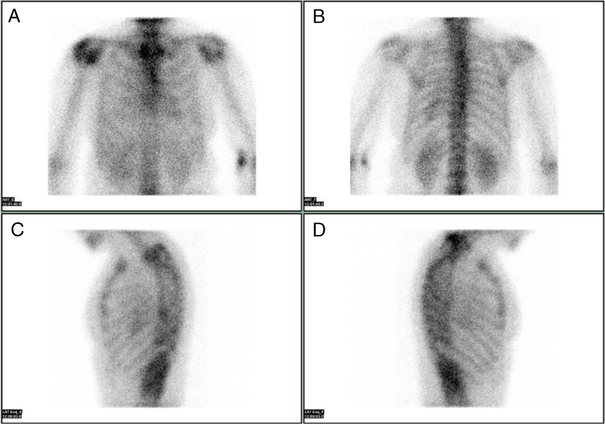 Mitral Annular Calcification as a Potential False-Positive for Cardiac Amyloidosis in 99mTc-DPD Scintigraphy Accurately Identified by SPECT/CT