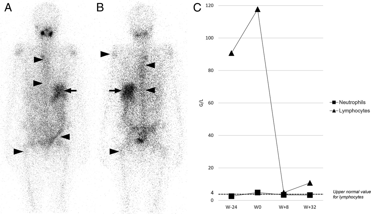 Diffuse Bone Uptake of 131I and Effect on Blood Counts in a Patient With Papillary Thyroid Carcinoma and Chronic Lymphocytic Leukemia