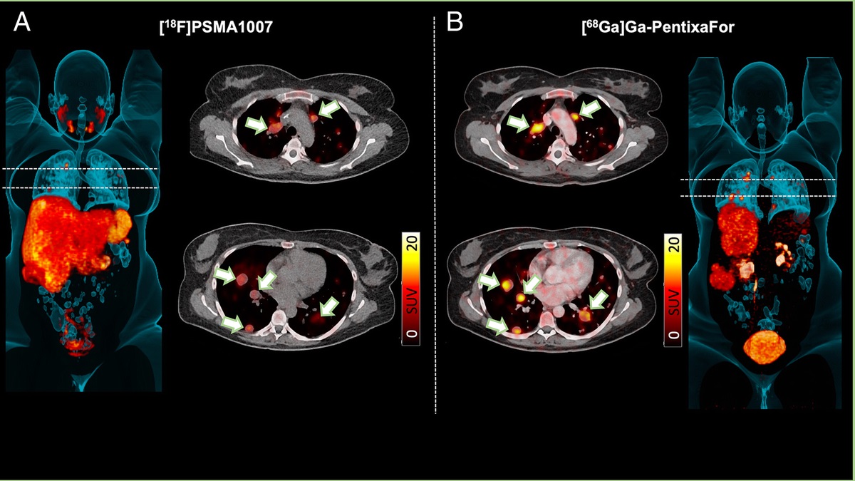 Exploring Theranostic Avenues in Adrenocortical Carcinoma Using Chemokine Receptor and Prostate-Specific Membrane Antigen–Directed PET/CT