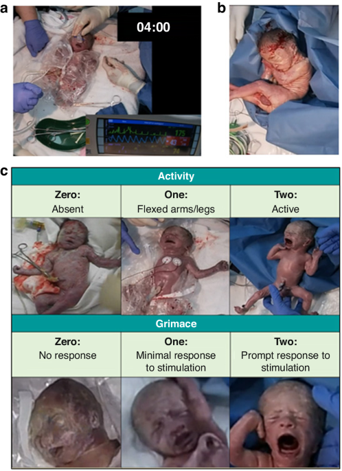 Combining activity and grimace scores reflects perinatal stability in infants <32 weeks gestational age