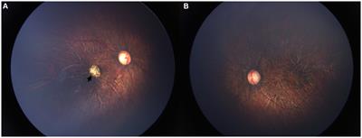Retinal detachment with multiple macrocysts in Stickler syndrome: case report and review of the literature