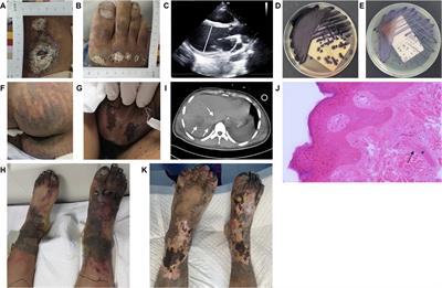 Critical bloodstream infection caused by Chromobacterium violaceum: a case report in a 15-year-old male with sepsis-induced cardiogenic shock and purpura fulminans