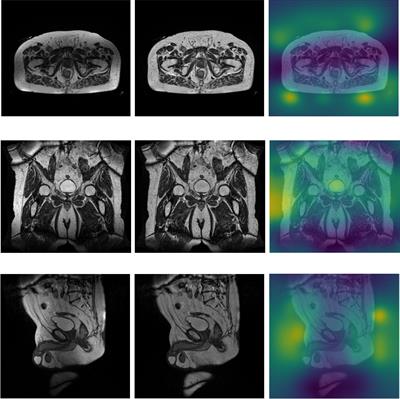 Impact of bias field correction on 0.35 T pelvic MR images: evaluation on generative adversarial network-based OARs’ auto-segmentation and visual grading assessment