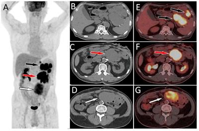 Case report: detection of multiple sporadic gastrointestinal stromal tumors by dual-time 18 F-FDG PET/CT