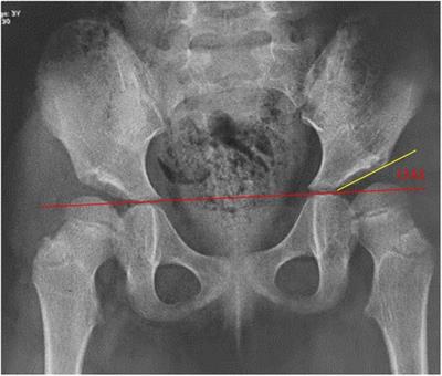 The role of the cartilaginous to osseous acetabular angle ratio in children with developmental dysplasia of the hip
