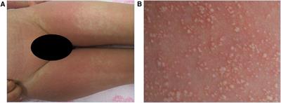 Case Report: Kawasaki disease associated with acute generalized exanthematous pustulosis secondary to carbocysteine