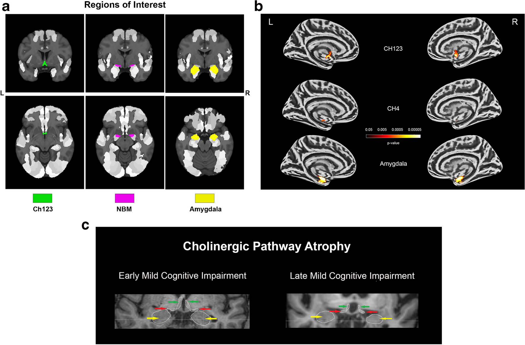 Atrophy of the cholinergic regions advances from early to late mild cognitive impairment