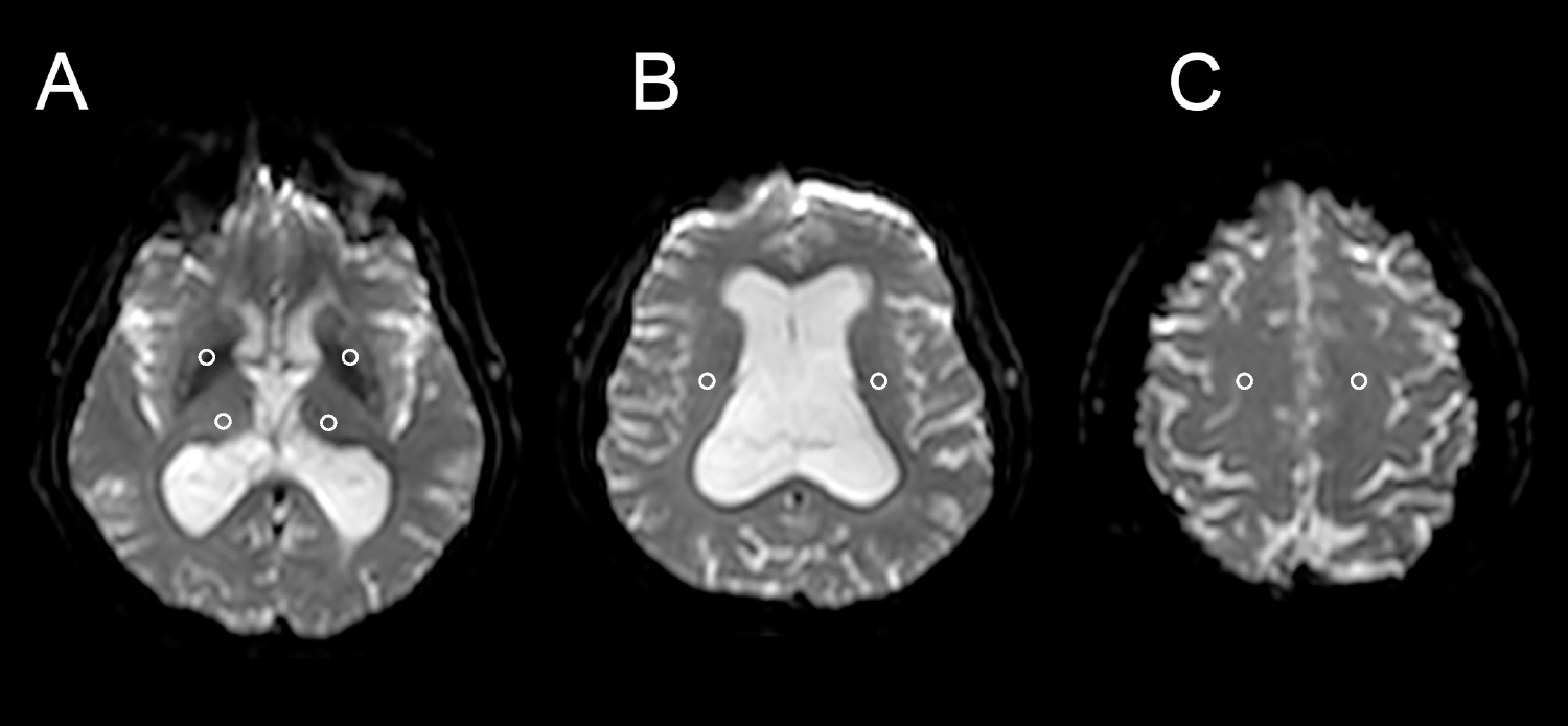 Intravoxel incoherent motion magnetic resonance imaging in the assessment of brain microstructure and perfusion in idiopathic normal-pressure hydrocephalus