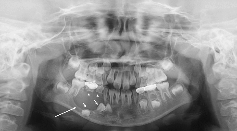 A case of radicular cyst on deciduous tooth in a 7-year-old child