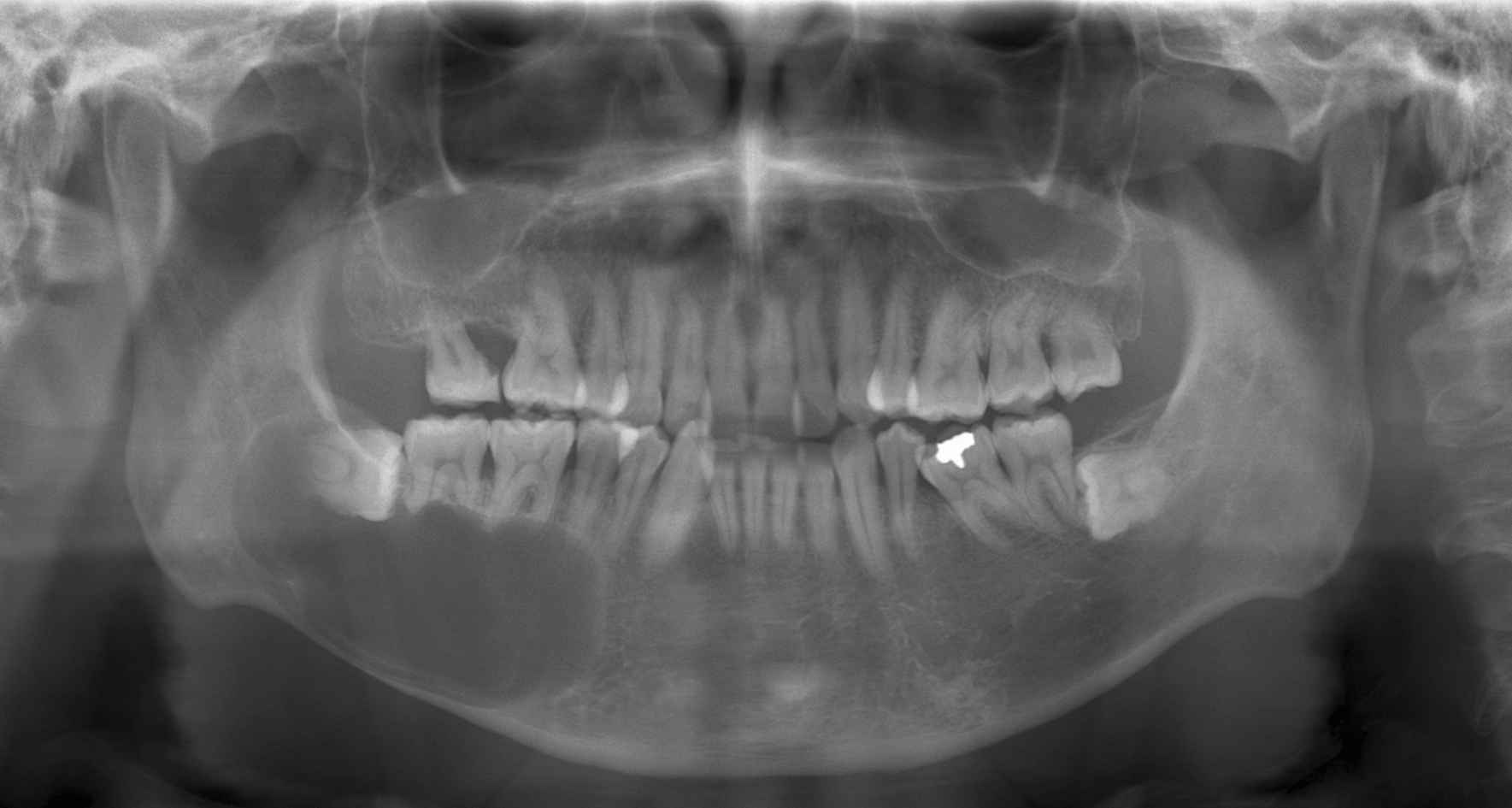 Dentigerous cysts suspected the other odontogenic lesions on panoramic radiography and CT