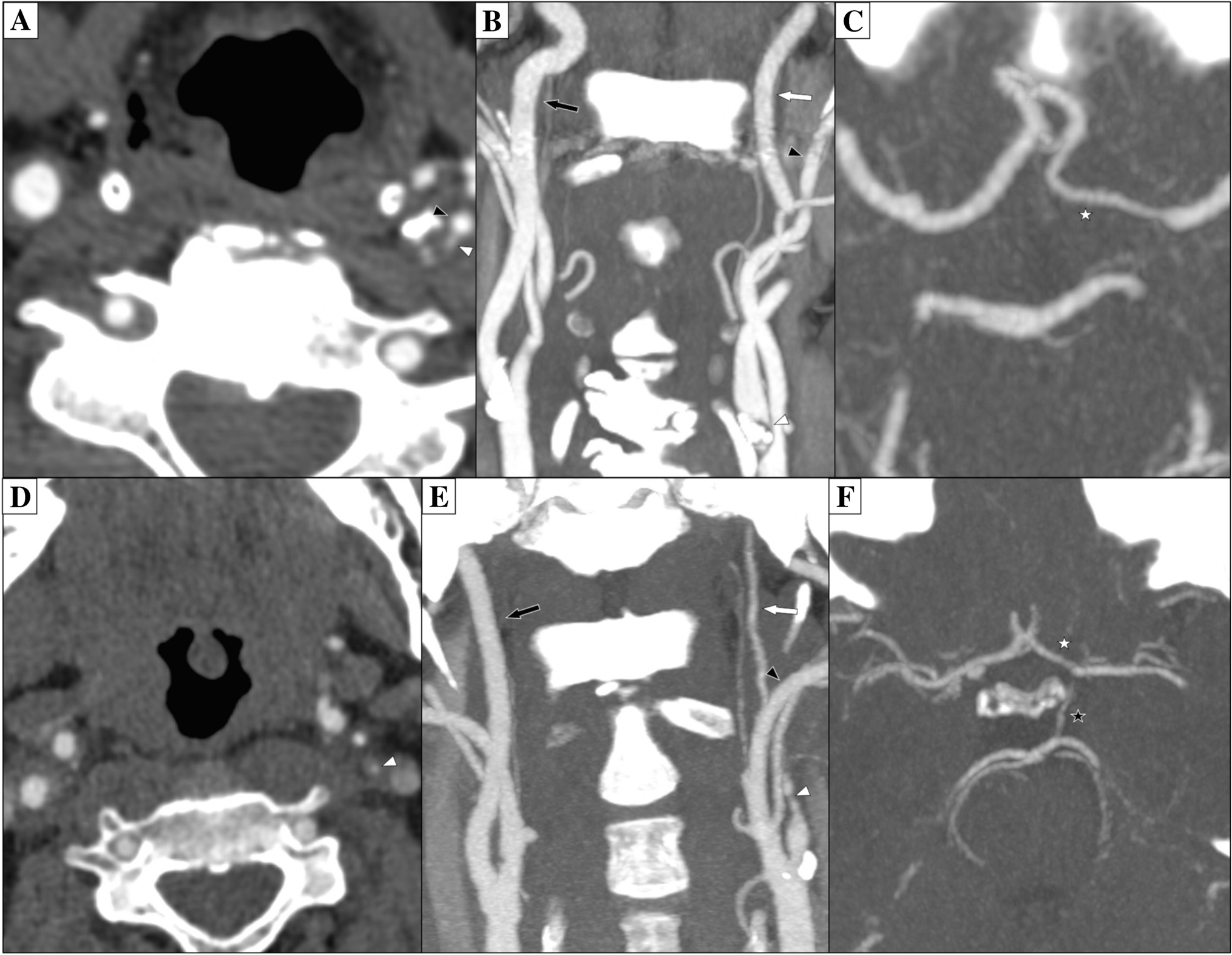 Phase-contrast magnetic resonance imaging of intracranial and extracranial blood flow in carotid near-occlusion