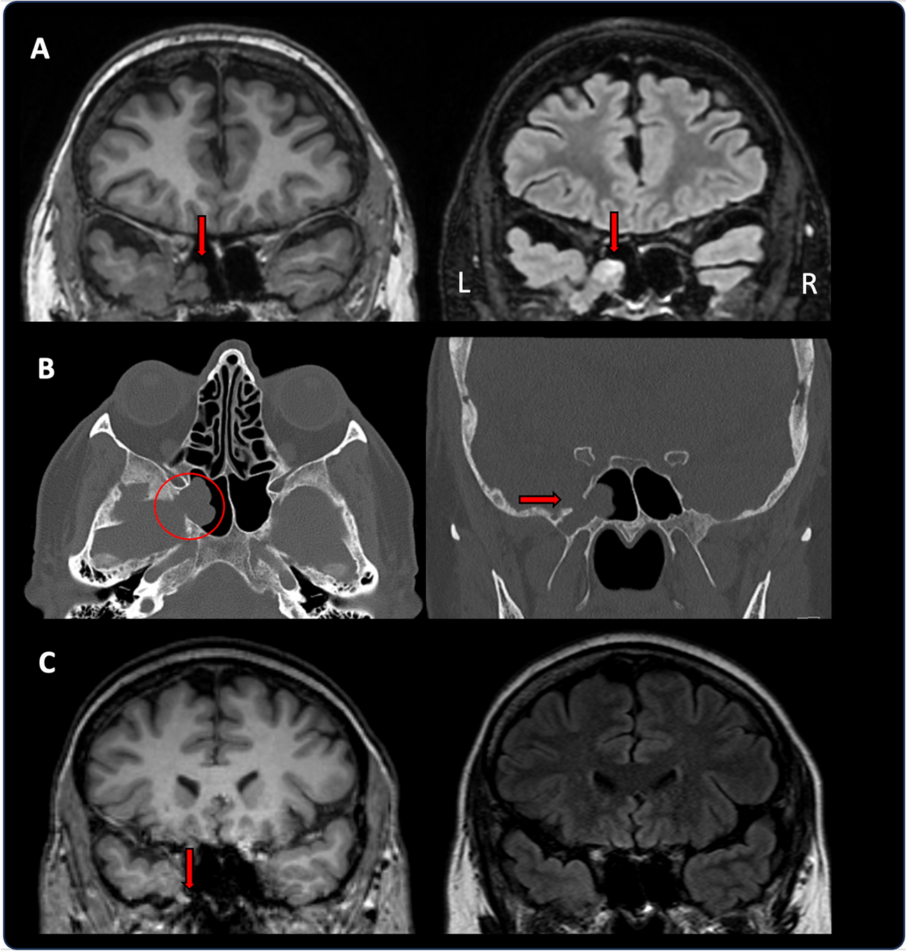 When the brain moves away: a case of sphenoidal sinus encephalocele