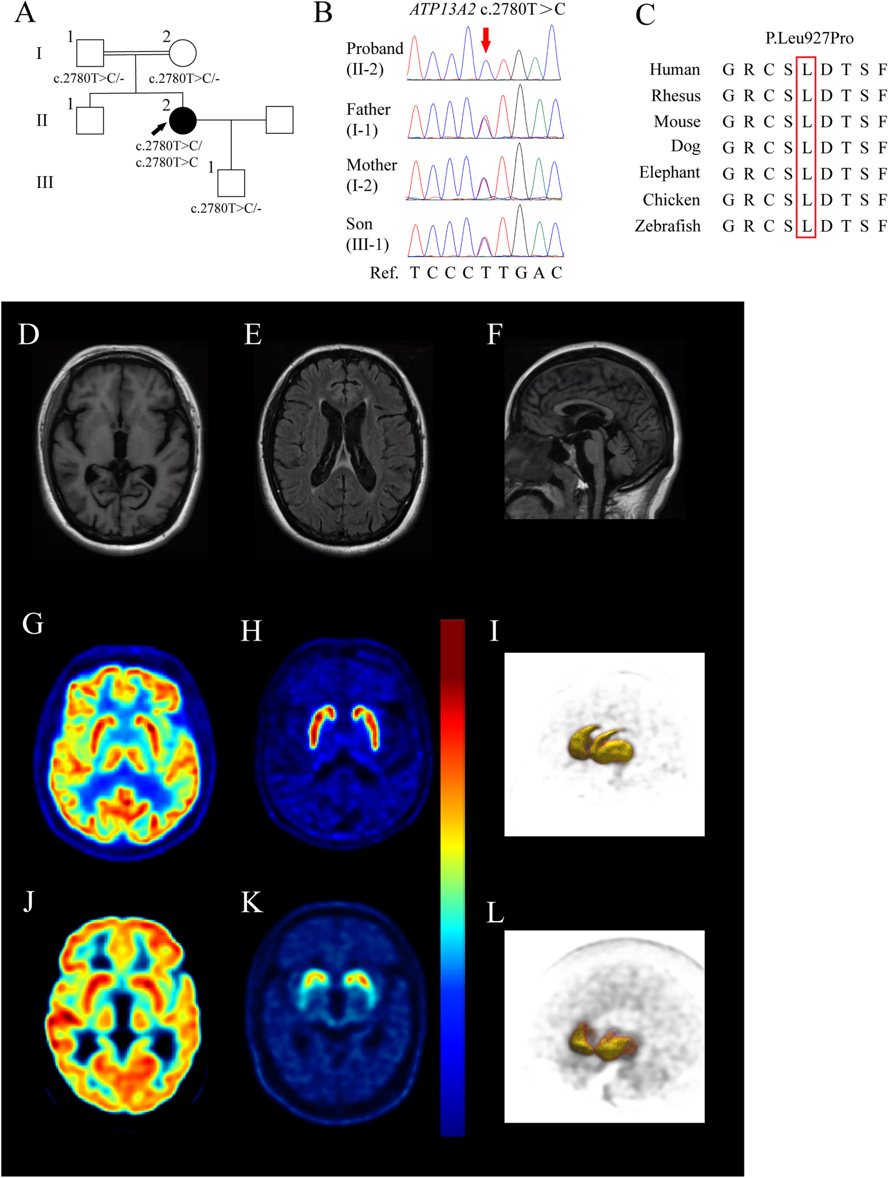 A novel ATP13A2 variant causing complicated hereditary spastic paraplegia