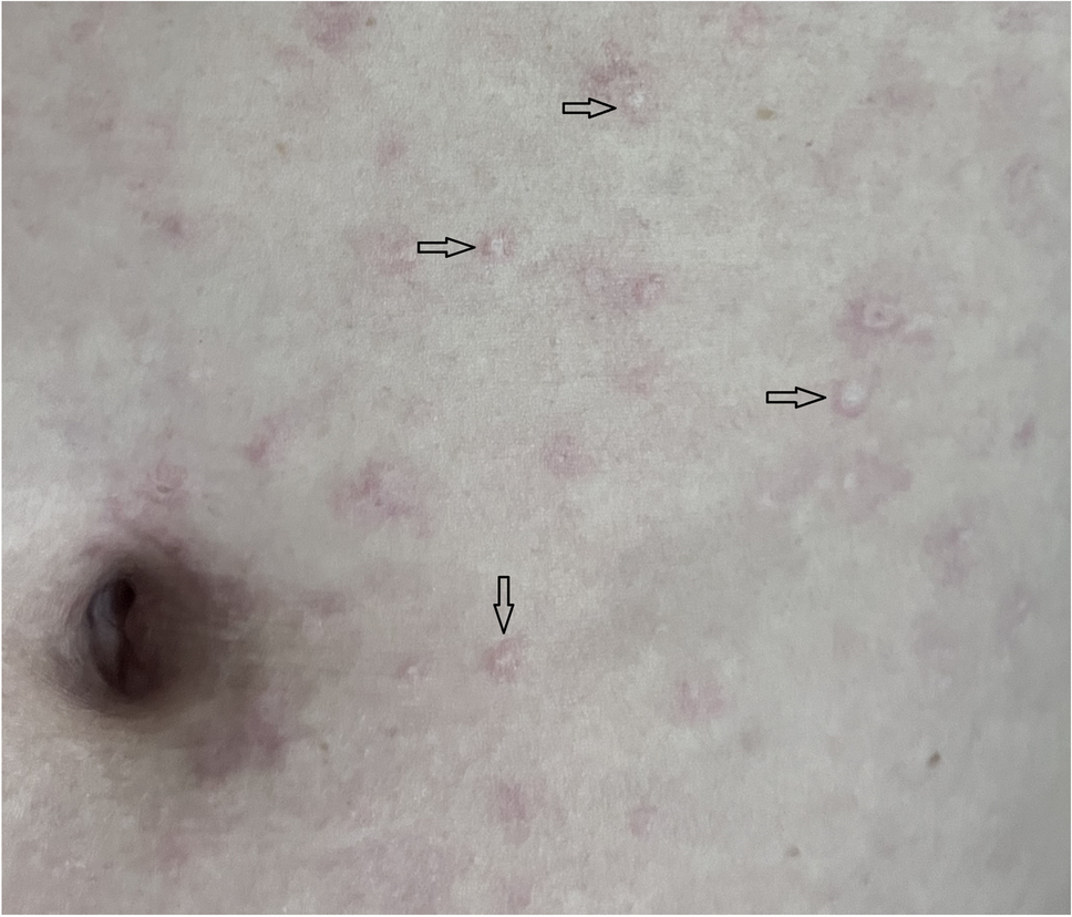 Malignant atrophic papulosis (Degos disease) with central nervous system involvement