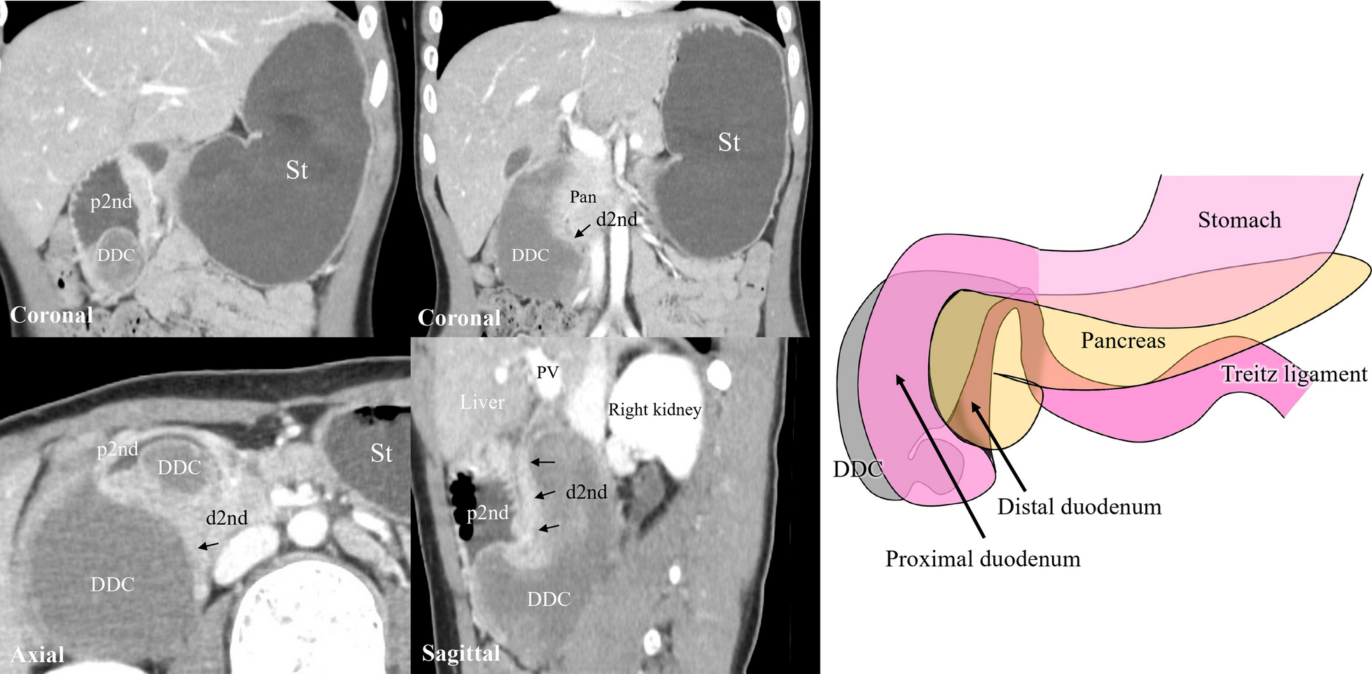 Duodenal duplication cyst at the second part of the duodenum with congenital duodenal position anomaly completely resected by laparoscopic partial duodenectomy: a case report