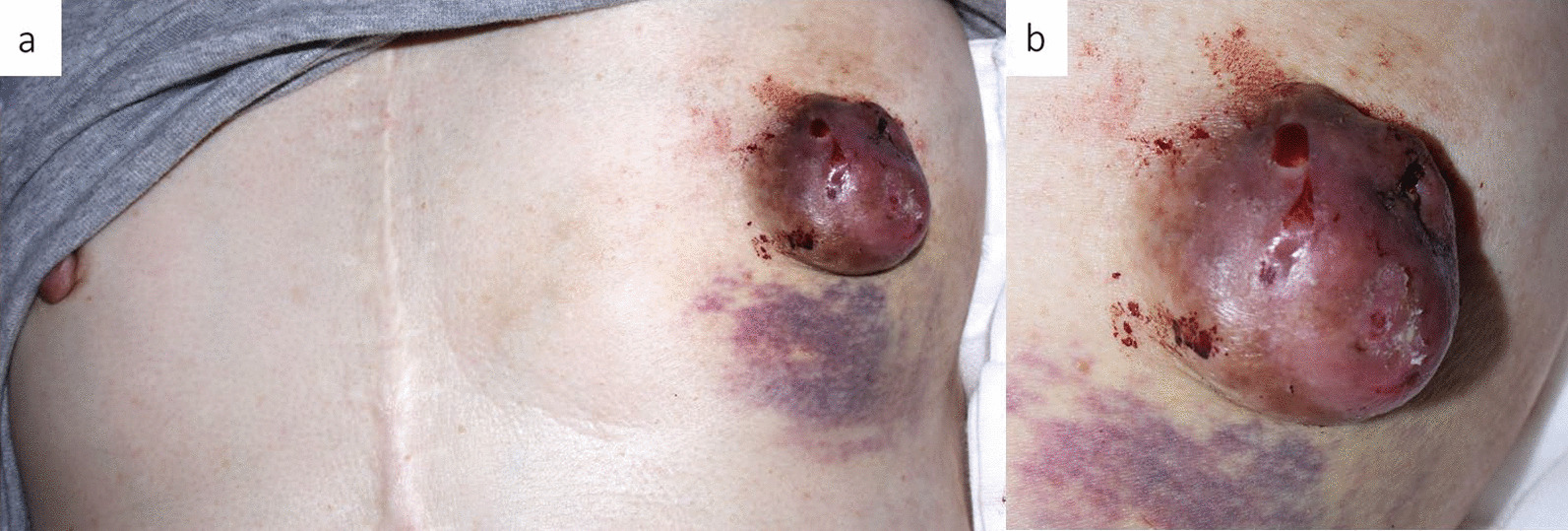 A case of giant nipple adenoma