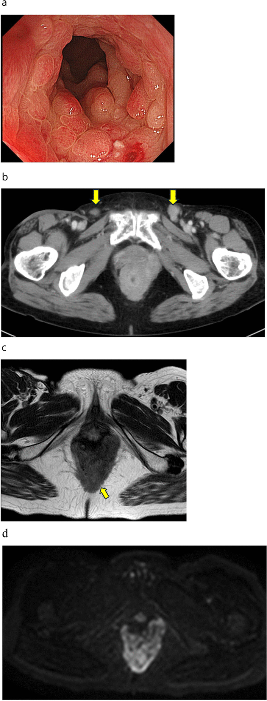 Squamous cell carcinoma of the anus successfully treated with multidisciplinary therapy for metachronous metastatic and local recurrences after DCF chemotherapy: a case report